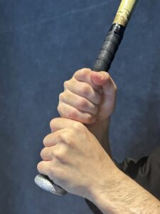 バッティング時の手のひらの痛み ― 有鉤骨疲労骨折とは